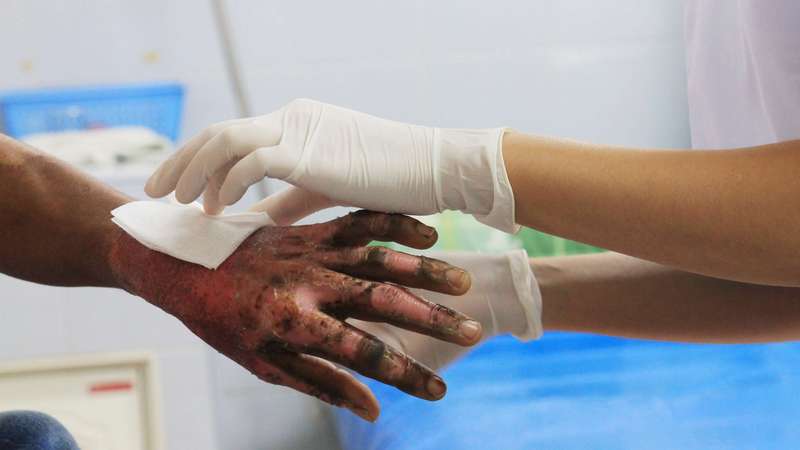 Տղամարդը որը ողջ-ողջ այրել է նախկին կնոջը 60-70 տոկոս այրվածք է ստացել